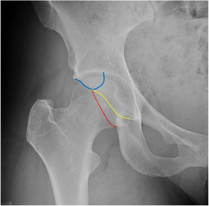 Extra-articular hip impingement: subspine, iliopsoas, and ischiofemoral impingement.