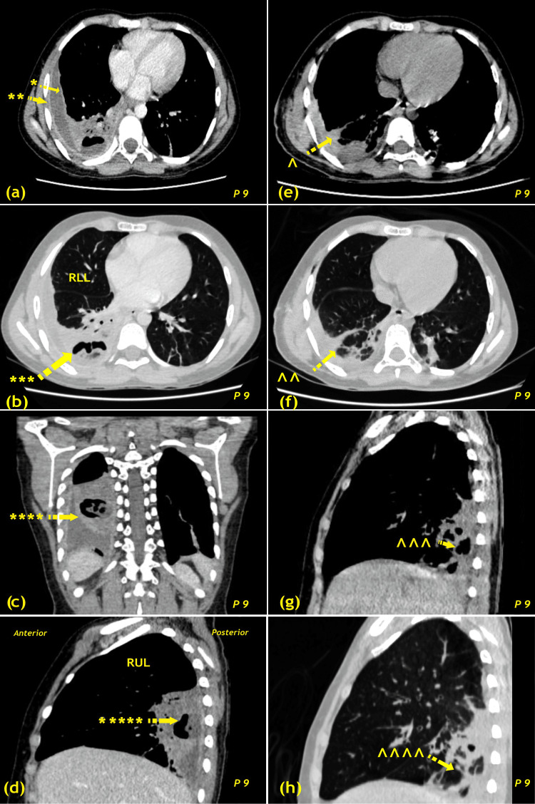 Early Thoracotomy and Decortication in Pleural Empyema.