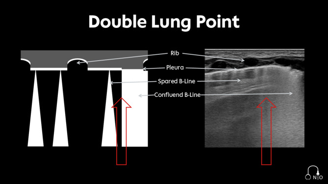 Pleura-ABCDE - a structured expert-based protocol for neonatal lung ultrasound documentation and interpretation.
