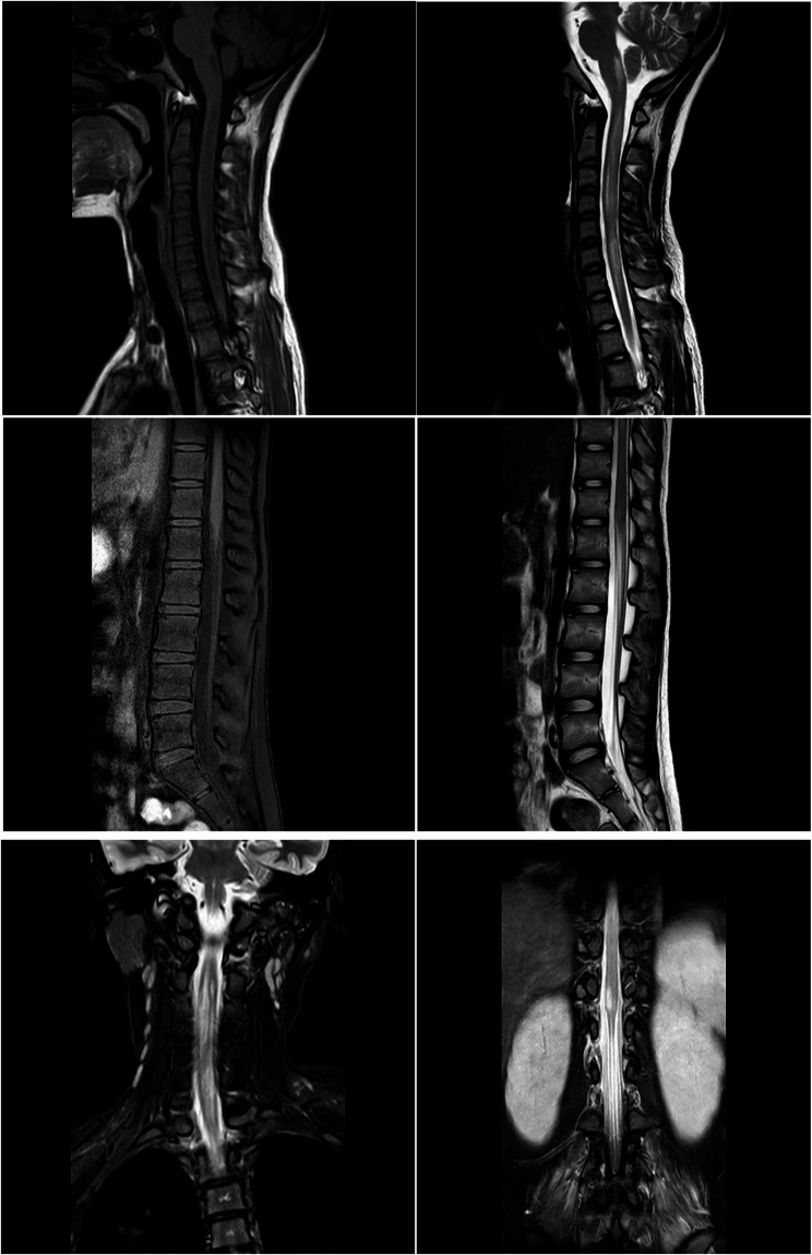 Mycoplasma pneumoniae infection and concurrent aquaporin-4-positive neuromyelitis optica spectrum disorder: a case report and literature review.