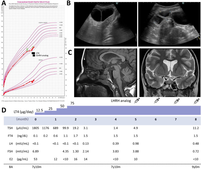 Van Wyk-Grumbach syndrome: a case report and review of the literature.