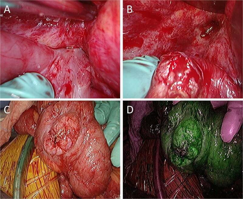 Prophylactic intestinal resection following carbon-ion radiotherapy for locally recurrent rectal cancer: a case report.