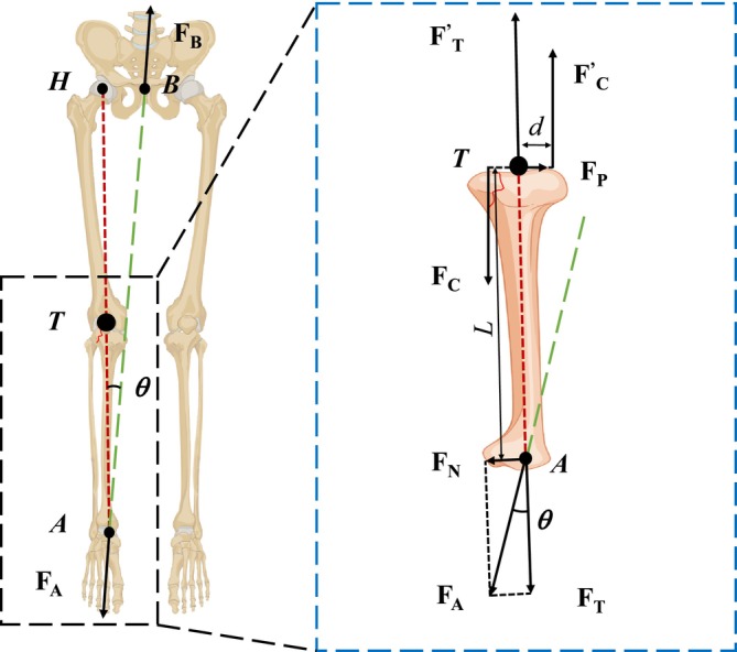 Equilibrium Mechanics in Fracture Reduction of Tibial Plateau.