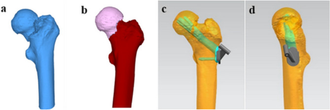 3D-printed navigation-guided FNS-CCS fixation reduces complications in young adults with comminuted femoral neck fractures: a retrospective cohort study.