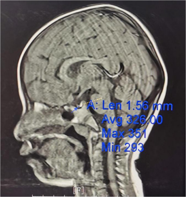 Treatment of a case with short stature and Goltz syndrome with long-acting growth hormone: a case report and follow-up.