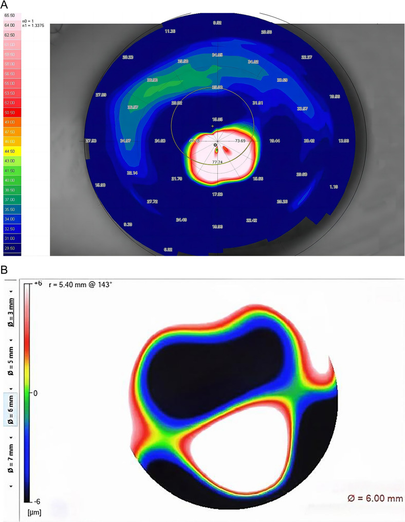 Halo sign in keratoconus: a case report.