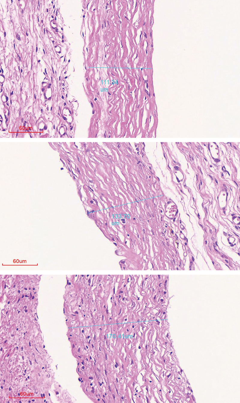 Comparative Study of Inflammatory and Fibrotic Reactions Induced by Silicone Implants with Different Hardness.