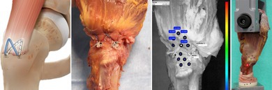 Superior Primary Stability of a Knotless Double-Row Construct Compared to Mason-Allen Repair for Anatomical Refixation of Gluteal Tendons-Biomechanical Human Cadaver Study.