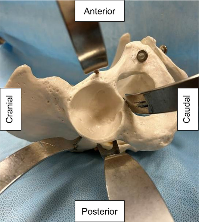 Comparison of quadricep motor evoked potentials between different surgical positions during total hip arthroplasty.
