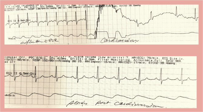 Serial electrical cardioversion for refractory atrial fibrillation with rapid ventricular response post ablation.