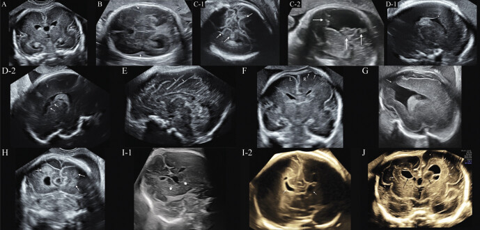 Relationship between prenatal ultrasound signs and genetic abnormalities for fetal malformations of cortical development.