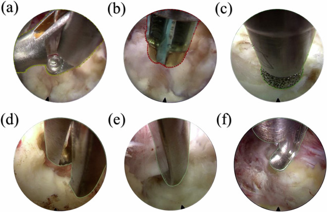 Spine endoscopic atlas: an open-source dataset for surgical instrument segmentation.