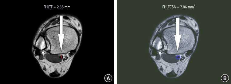 Diagnosis of flexor hallucis longus tenosynovitis using the cross-sectional area of the flexor hallucis longus tendon.