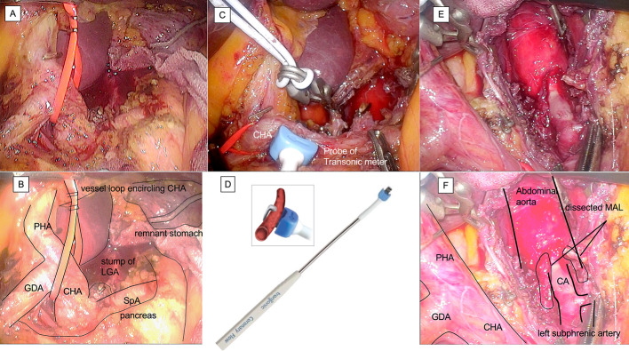 Intraoperative evaluation of median arcuate ligament syndrome using a transit-time flowmeter: a case report.