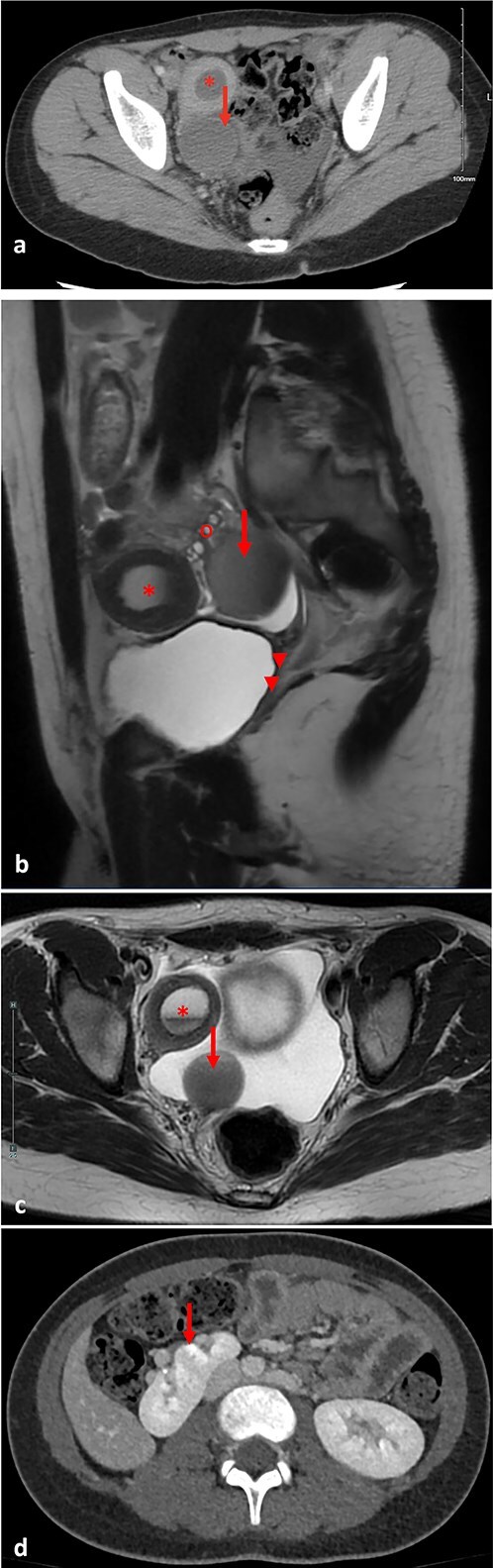 Mayer-Rokitansky-Küster-Hauser syndrome complicated by hematometra and hematosalpinx treated with laparoscopic uterine drain placement: a case report.