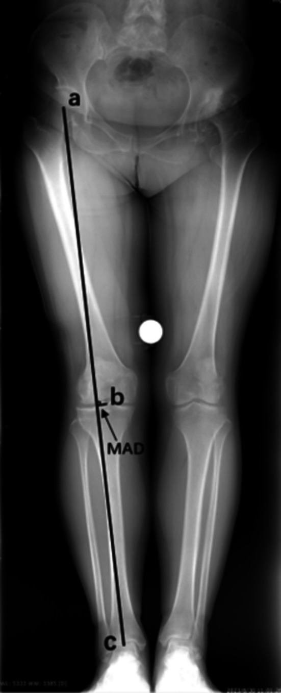 An Unnoticed Femoral Condyle Deformity in Transverse Plane Is Associated With Knee Valgus in Patients With Unilateral Developmental Dysplasia of the Hip.