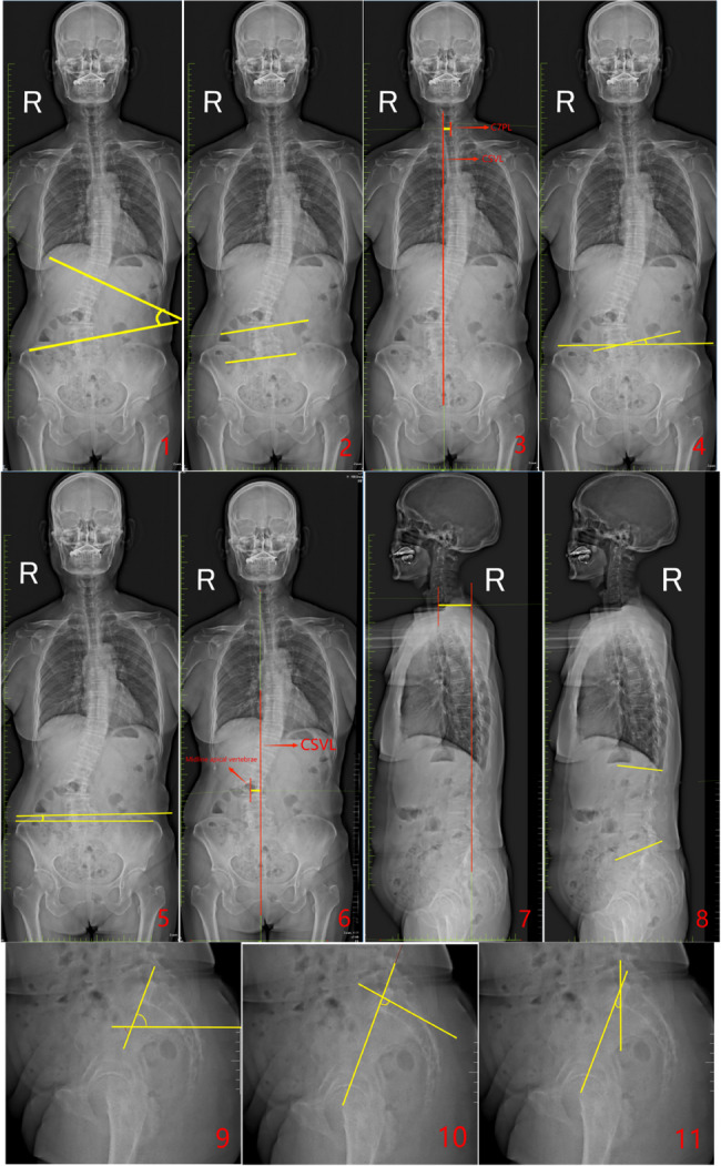 Preoperative coronal imbalance in degenerative scoliosis: a study on coronal and sagittal spinal-pelvic parameters--a retrospective study.