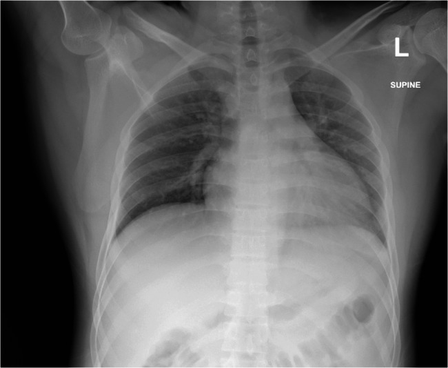 Isolated oculomotor nerve palsy in Neisseria meningitidis meningitis: a case report and literature review.