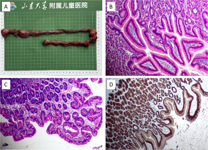 Laparoscopic-assisted resection of long-segment small bowel duplication: a rare case report and review of literature.