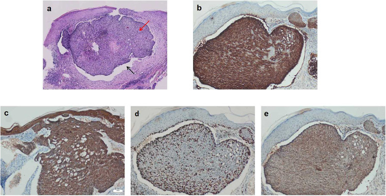 An Atypical Presentation of Basal Cell Carcinoma: A Giant Verrucous Ulcer on the Upper Arm.