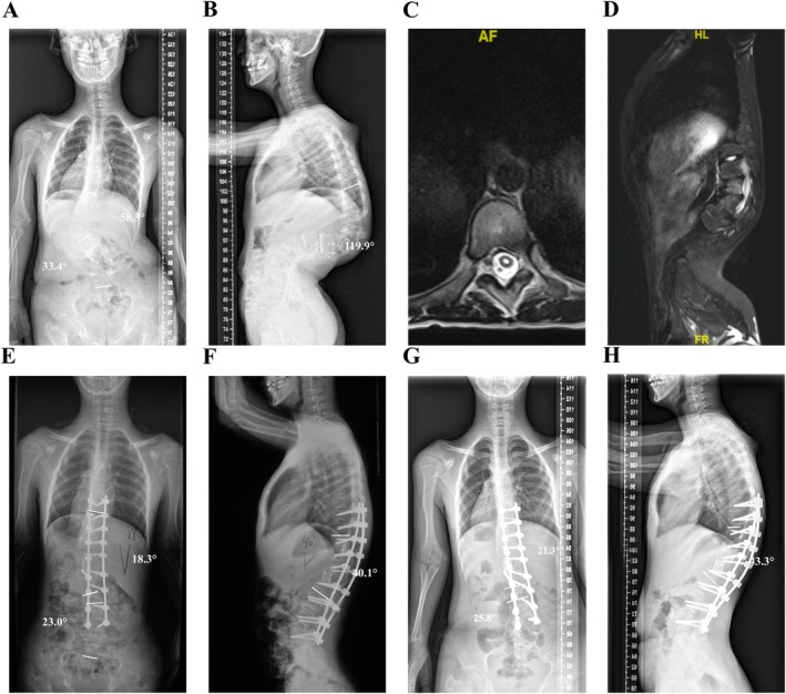 Risk Factors for Neurological Complications in Severe Spinal Deformity Surgery.