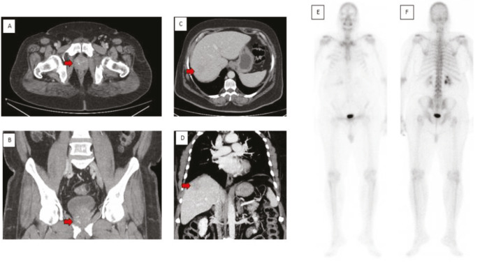 Triple Tumors Uncovered: Insights from <sup>68</sup>Ga PSMA PET-CT.