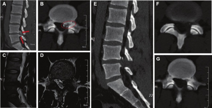 Sagittal Classification of Calcified Lumbar Disc Herniation and Therapeutic Analysis of Percutaneous Endoscopic Interlaminar Discectomy.