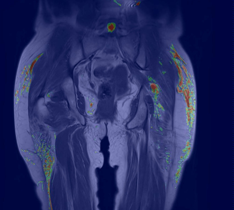 Surgical Approach for Sciatic Nerve Entrapment Secondary to Biopolymer Injection.