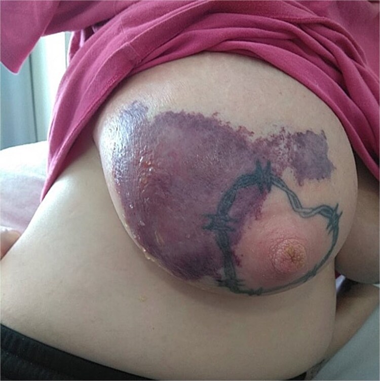 A rare case of necrotic erysipelas of the breast in a healthy, postpartum female.