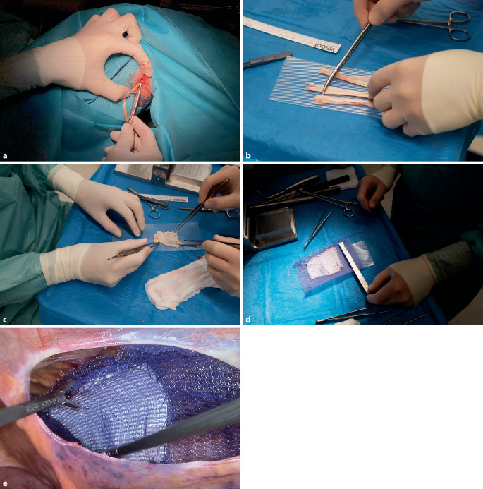 [Learning from others-semitendinosus tendon autograft for inguinal hernia repair (HoTT-TAPP) : Case series with demonstration of feasibility].