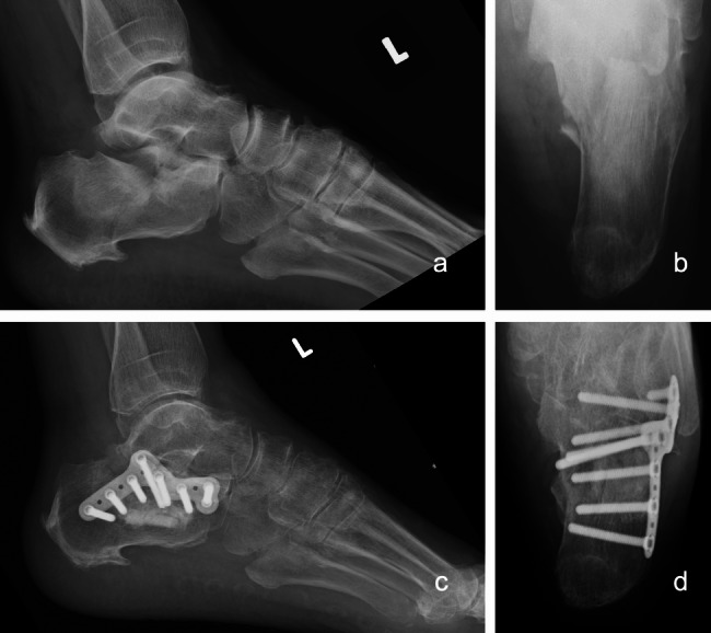 Clinical and radiologic outcomes of minimally invasive locking plate versus screw fixation for displaced intra-articular calcaneal fractures (DIACFs) via sinus tarsi approach: a comparative study.