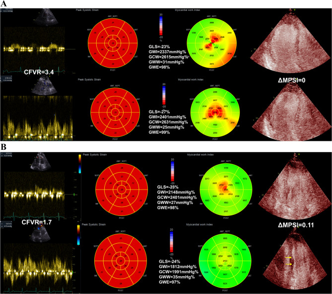 Prognostic value of adenosine stress echocardiography in chronic coronary syndromes with preserved left ventricular ejection fraction.