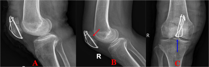 A novel approach to the minimally invasive application of a tension band for transverse patellar fractures assisted by a nice knot.