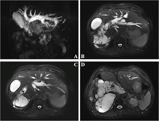 Palliative cholangiojejunostomy for refractory biliary obstruction in mucinous cholangiocarcinoma: a case report.