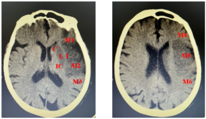 Large artery atherosclerotic versus cardioembolism subtypes of large hemispheric infarction in the middle cerebral artery.