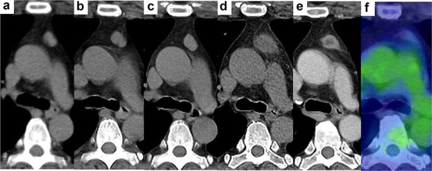 Regressed anterior mediastinal nodule secondary to removal of dental crowns.