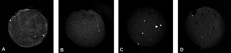 The Effect of Cement Thickness on Shear Bond Strength of Zirconia with Three Different Self-Adhesive Resin Cements.