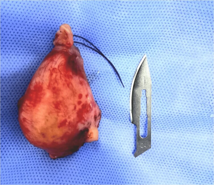 Neuroendocrine tumor of the appendix associated with an appendiceal mucocele: an incidental discovery during breast tumor surveillance.