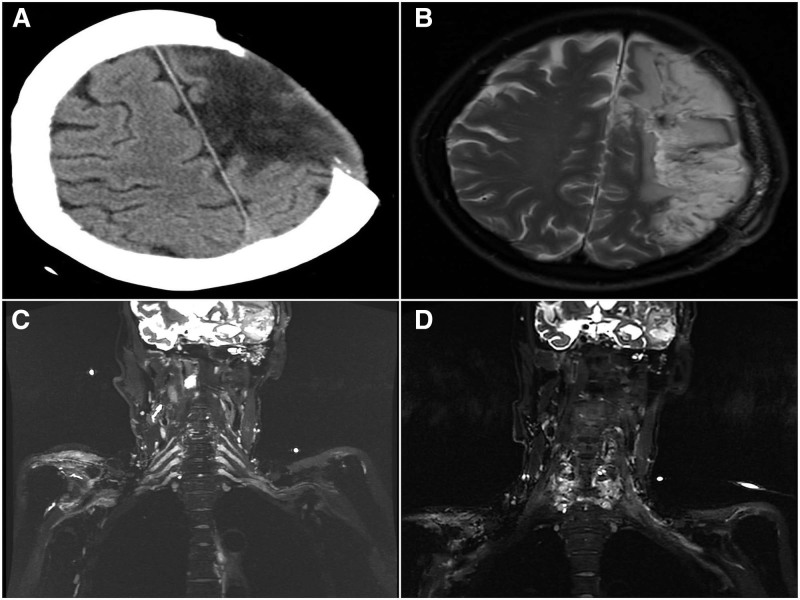 Posterior versus anterior approach for contralateral C7 nerve transfer in post-stroke upper limb spastic hemiplegia: A comparative retrospective study.