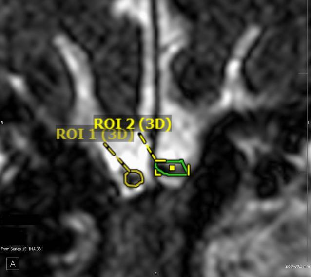 [Volumetry of the olfactory bulb - One component in the objectification of disorders of the sense of smell].