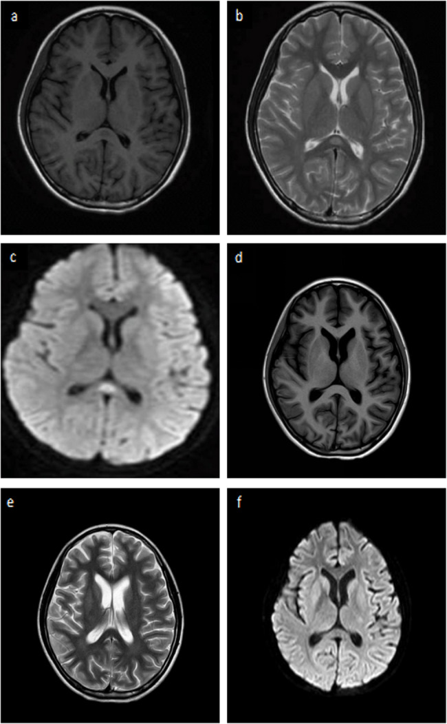 Mycoplasma pneumoniae infection and concurrent aquaporin-4-positive neuromyelitis optica spectrum disorder: a case report and literature review.