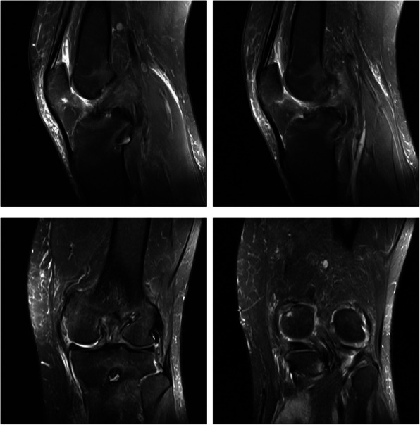 Septic arthritis or adult-onset still's disease: analyzing the causes of recurrent fever after arthroscopic combined anterior cruciate ligament and posterior cruciate ligament reconstruction: a case report.