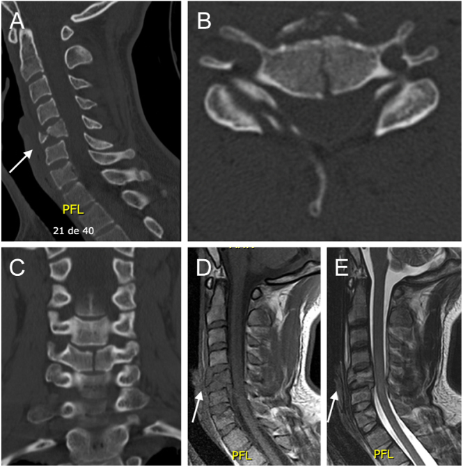 Flexion teardrop fracture of the cervical spine: a narrative review.