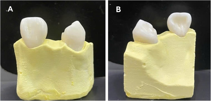 Evaluation of biomechanical behavior of all-ceramic cantilever resin-bonded fixed dental prostheses: a finite element analysis.