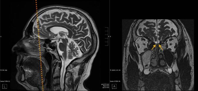 [Volumetry of the olfactory bulb - One component in the objectification of disorders of the sense of smell].