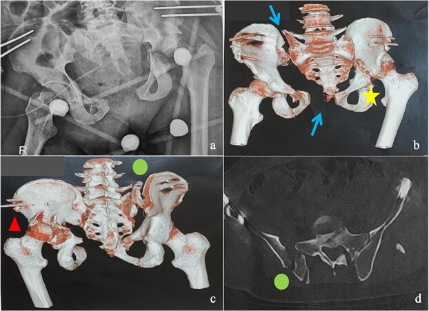 Surgical management of concomitant and delayed complex pelvic and acetabular fractures.