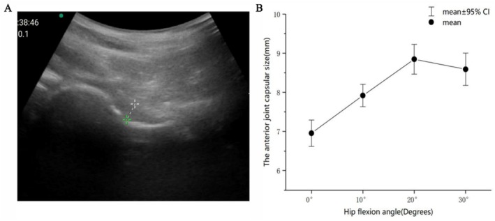 Comparison of the Clinical Efficacy of the Anterolateral and Regular Approaches for Hip Joint Puncture: A Randomized Cross-Over Trial.