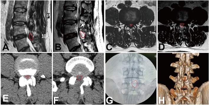 Efficacy and Safety of Unilateral Interlaminar Endoscopic Decompression for Lumbar Spinal Stenosis: A Retrospective Study of 176 Cases With a 3-6 Year Follow-Up.