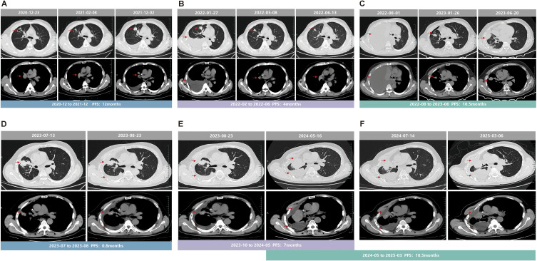 Case Report: A Rare EGFR 20 Insertion Variant, P772_H773insGNP Mediates Resistance to Sunvozertinib but Is Sensitive to Furmonertinib.