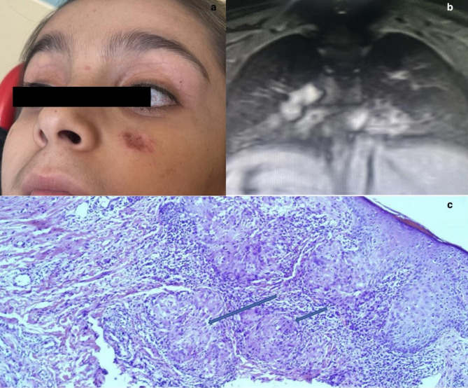 Expanding the clinical spectrum of pediatric ataxia-telangiectasia: a case series of novel genetic variants, lupus vulgaris, and hyper-IgM phenotypes.